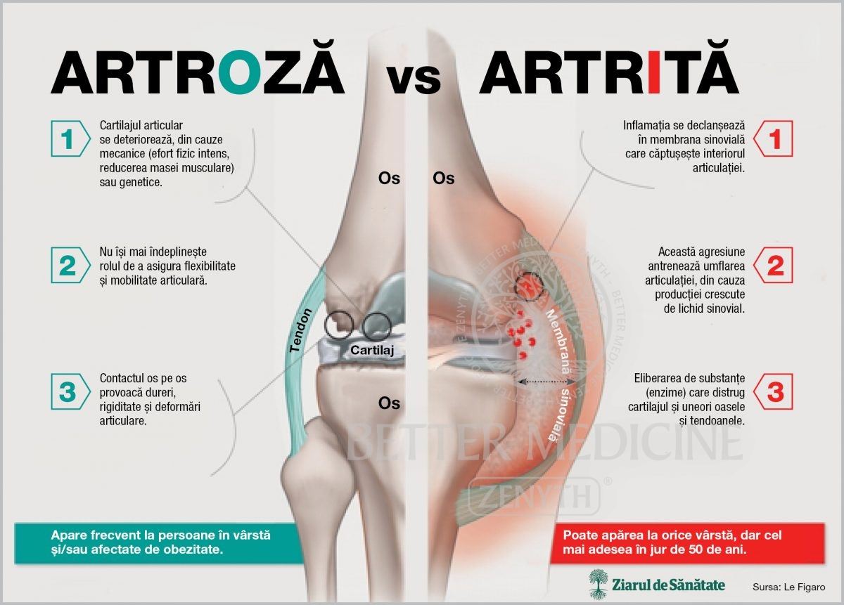 artroza provoacă tratamentul bolii