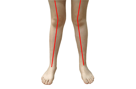 artroza deformantă a articulației genunchiului stâng 1-2 grade